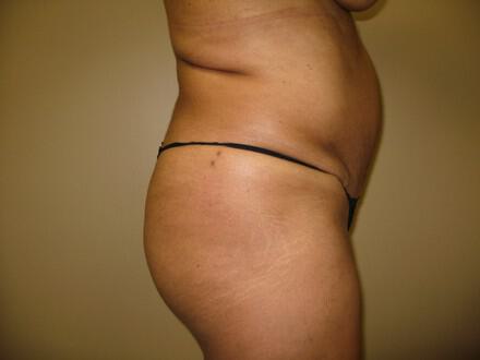 Buttocks Reshaping Before & After Image