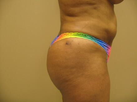 Buttocks Reshaping Before & After Image