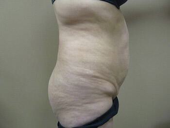 Buttocks Reshaping Before & After Image