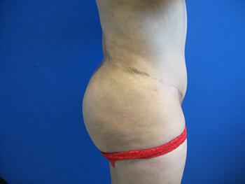 Buttocks Reshaping Before & After Image