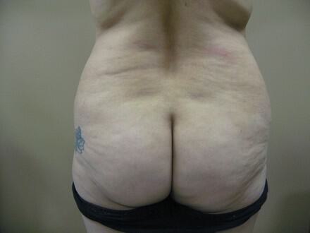 Buttocks Reshaping Before & After Image