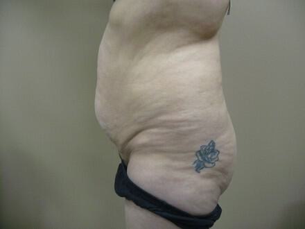 Buttocks Reshaping Before & After Image