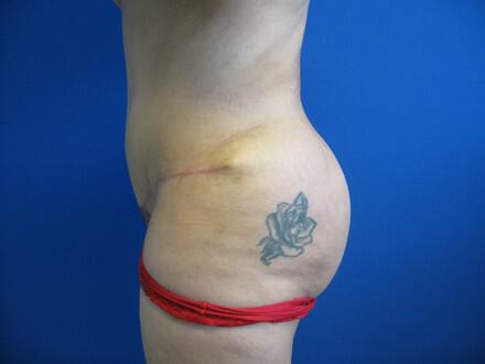 Buttocks Reshaping Before & After Image