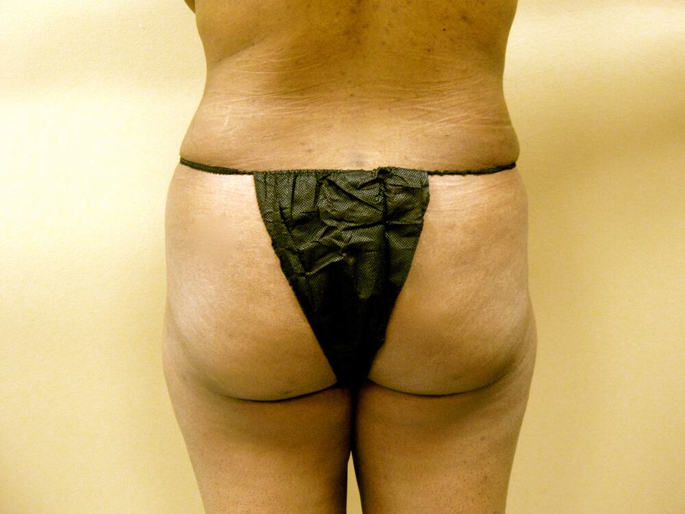 Buttocks Reshaping Before & After Image