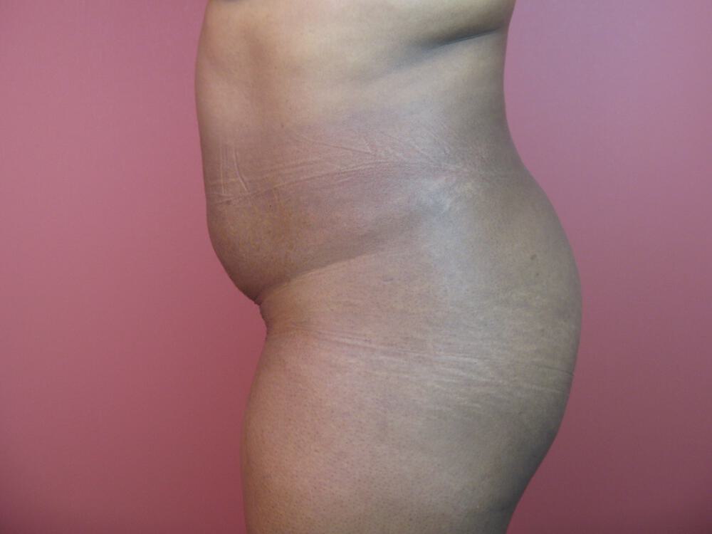 Buttocks Reshaping Before & After Image