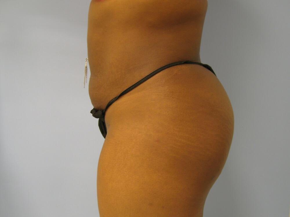Buttocks Reshaping Before & After Image