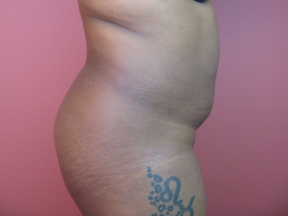 Buttocks Reshaping Before & After Image