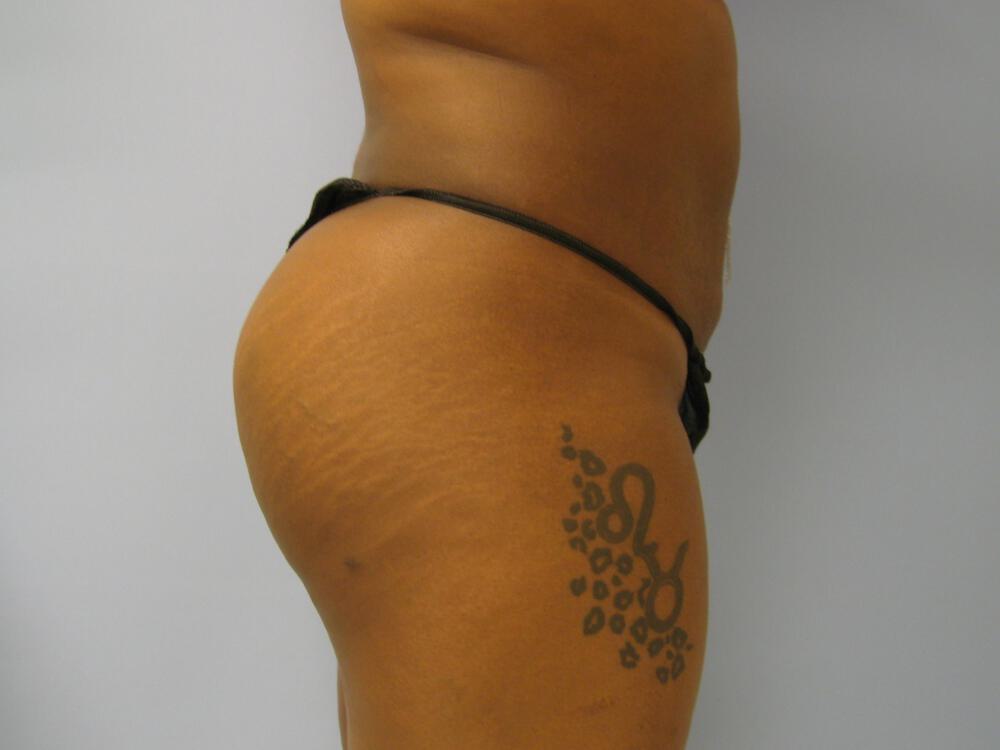 Buttocks Reshaping Before & After Image
