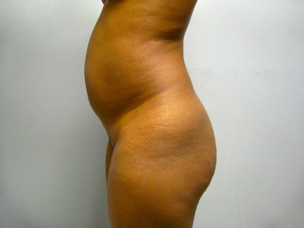 Buttocks Reshaping Before & After Image