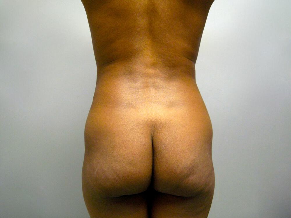 Buttocks Reshaping Before & After Image