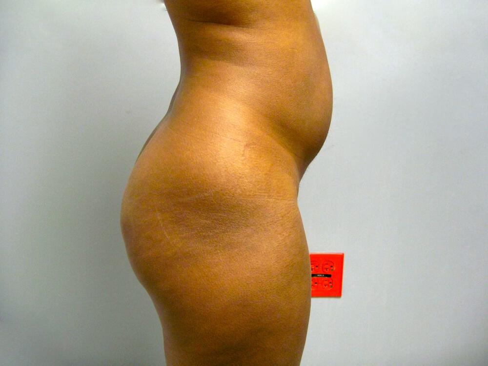 Buttocks Reshaping Before & After Image