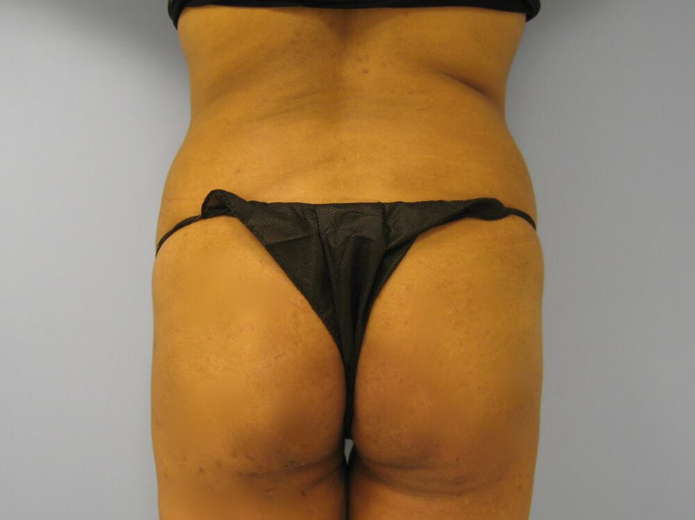 Buttocks Reshaping Before & After Image