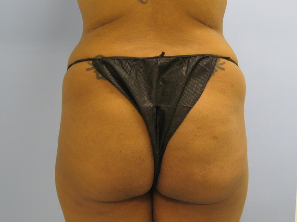 Buttocks Reshaping Before & After Image