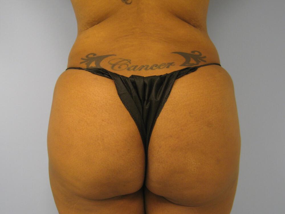Buttocks Reshaping Before & After Image