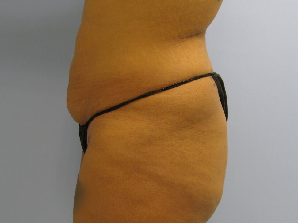 Buttocks Reshaping Before & After Image