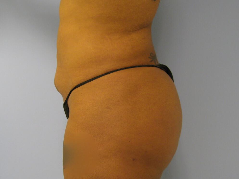 Buttocks Reshaping Before & After Image