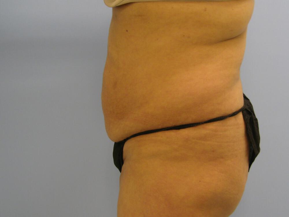 Buttocks Reshaping Before & After Image