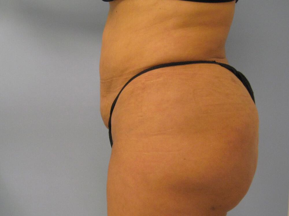 Buttocks Reshaping Before & After Image
