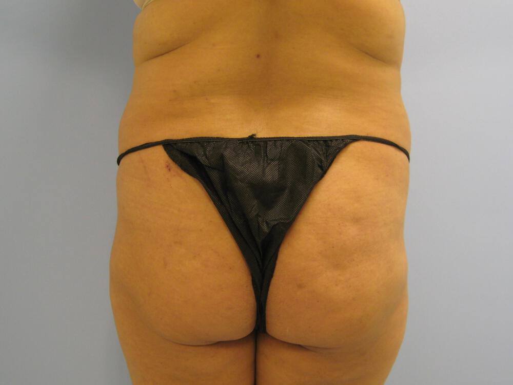Buttocks Reshaping Before & After Image