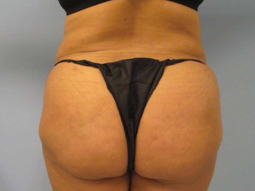 Buttocks Reshaping Before & After Image
