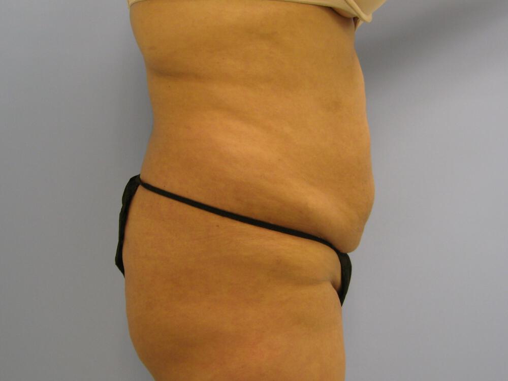 Buttocks Reshaping Before & After Image