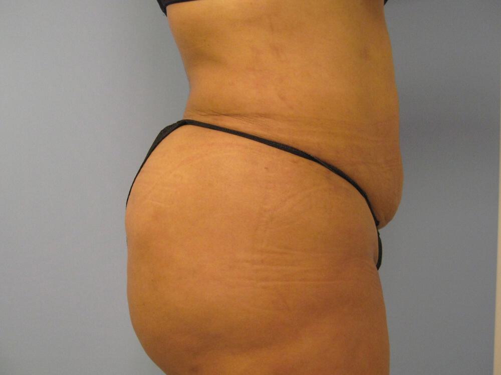 Buttocks Reshaping Before & After Image