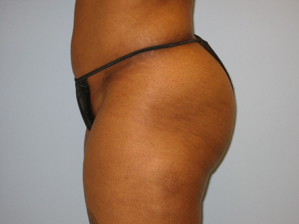 Buttocks Reshaping Before & After Image