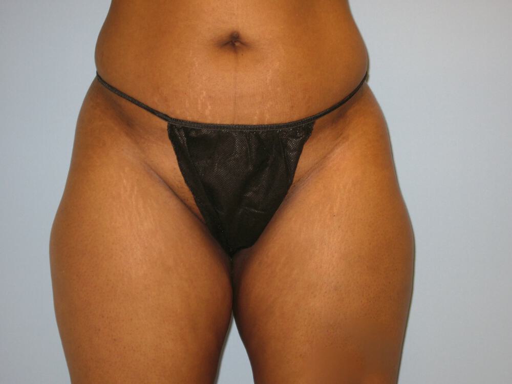 Buttocks Reshaping Before & After Image