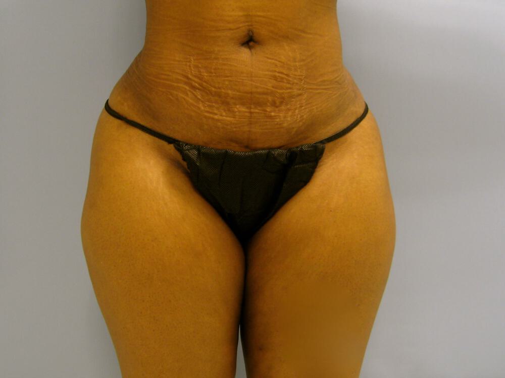 Buttocks Reshaping Before & After Image