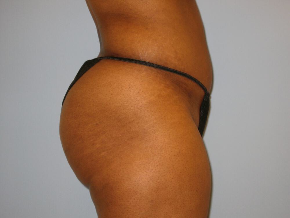 Buttocks Reshaping Before & After Image