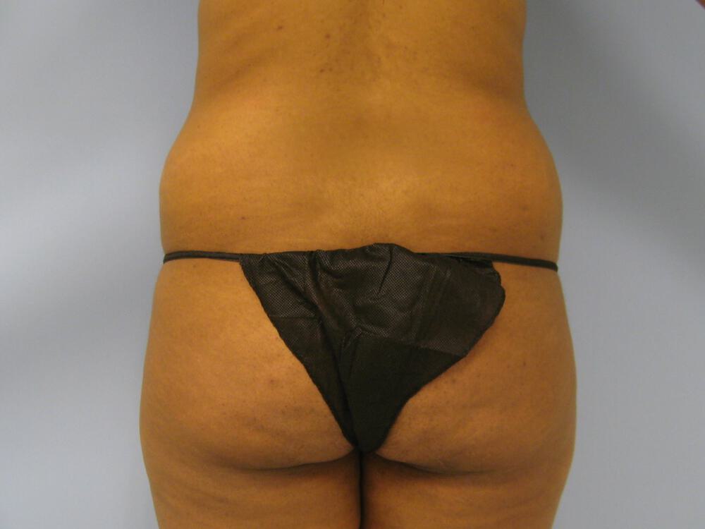Buttocks Reshaping Before & After Image