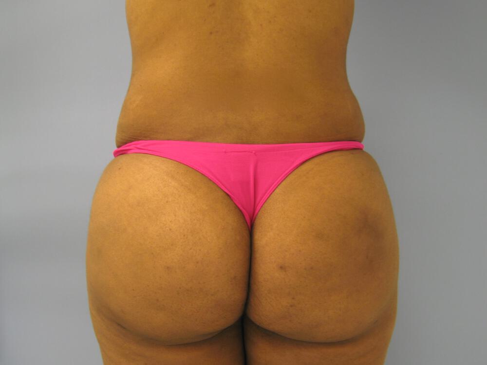Buttocks Reshaping Before & After Image