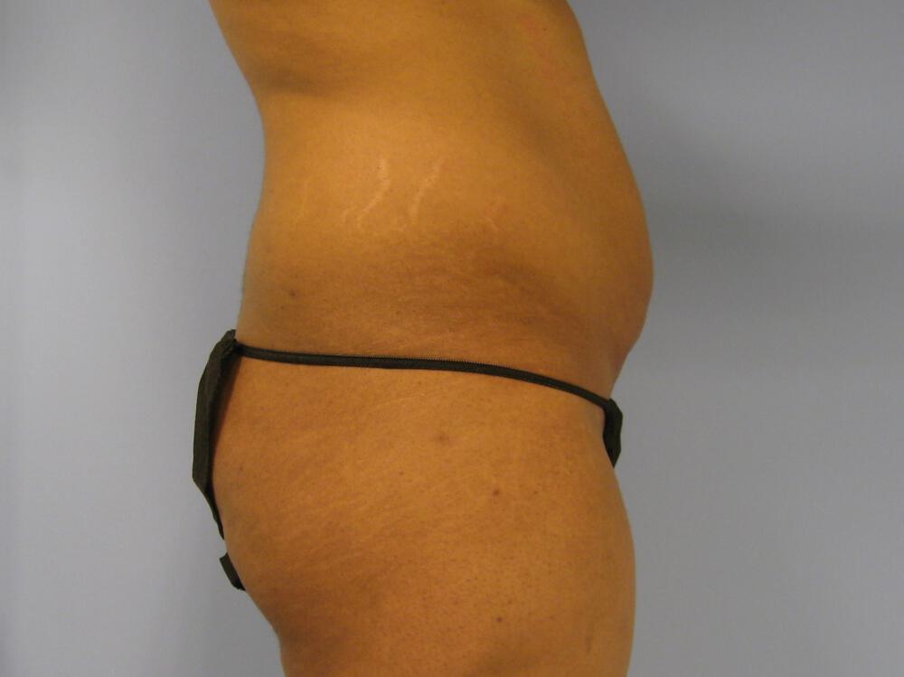Buttocks Reshaping Before & After Image