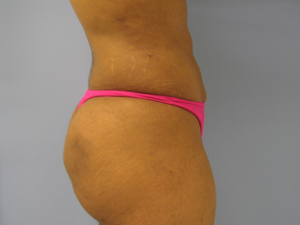 Buttocks Reshaping Before & After Image