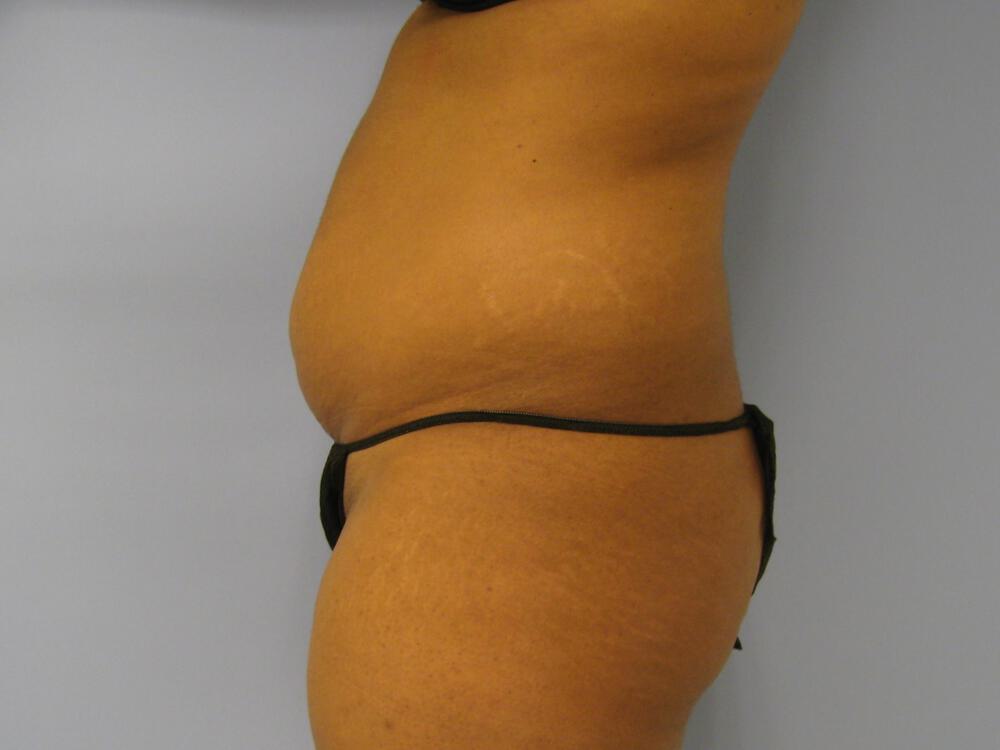 Buttocks Reshaping Before & After Image