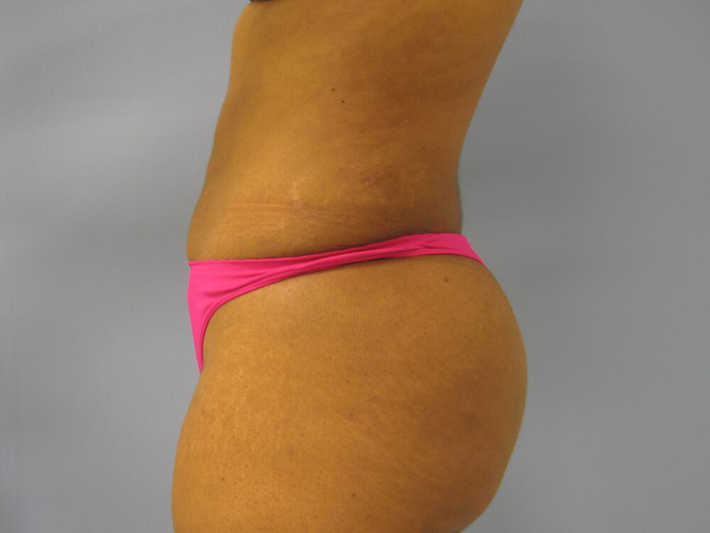Buttocks Reshaping Before & After Image