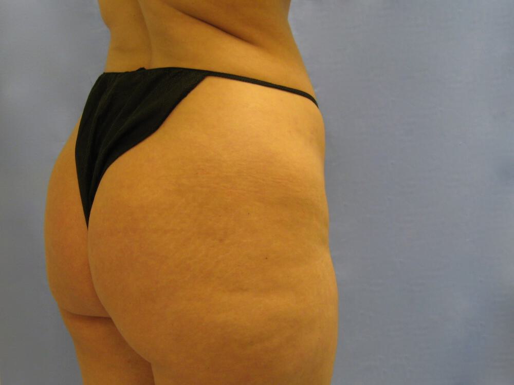 Buttocks Reshaping Before & After Image