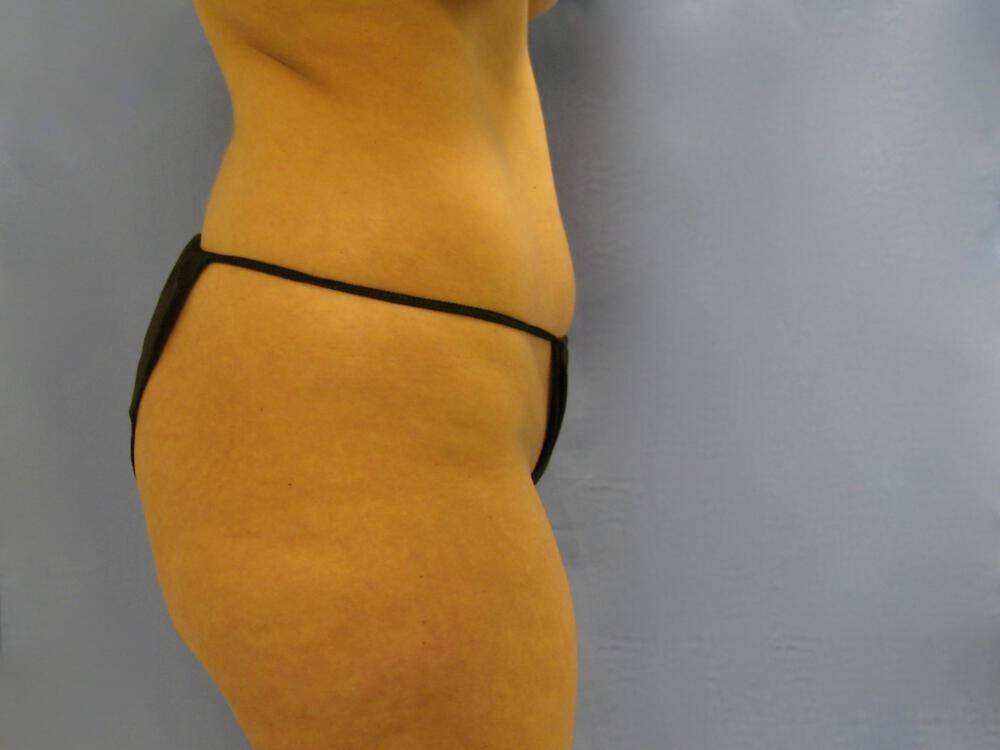 Buttocks Reshaping Before & After Image