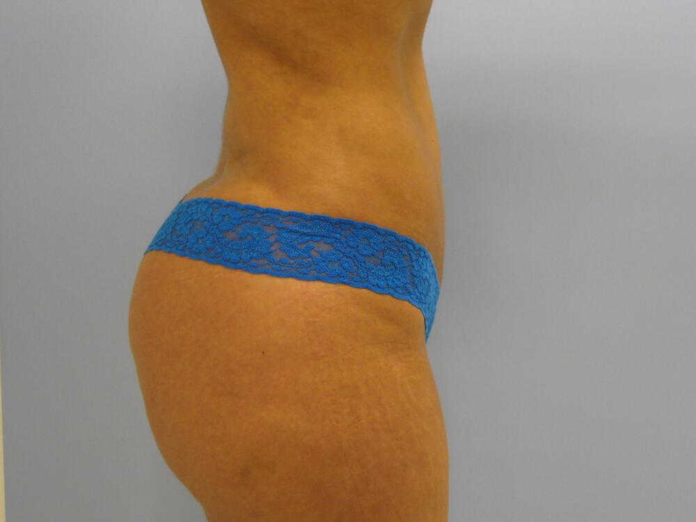 Buttocks Reshaping Before & After Image