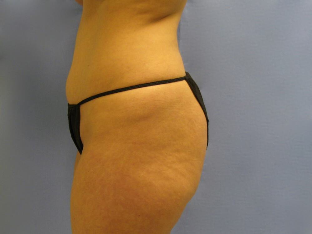 Buttocks Reshaping Before & After Image