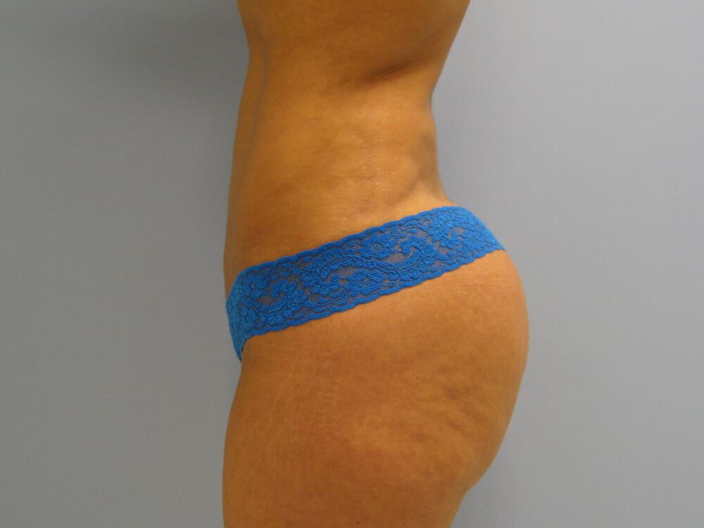 Buttocks Reshaping Before & After Image