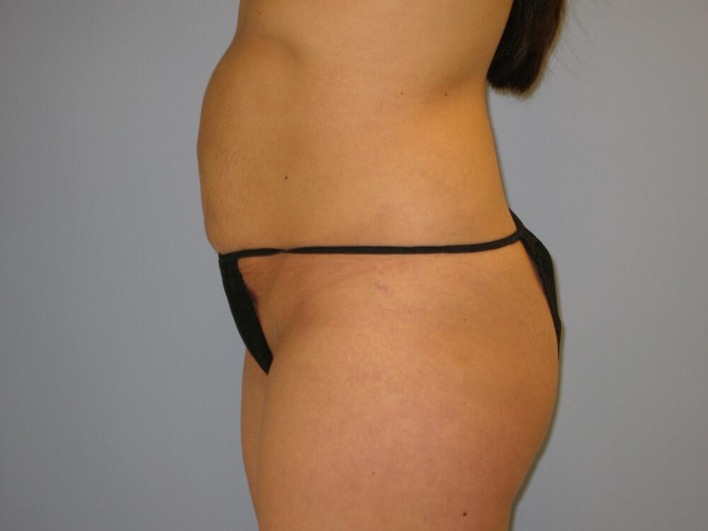 Buttocks Reshaping Before & After Image