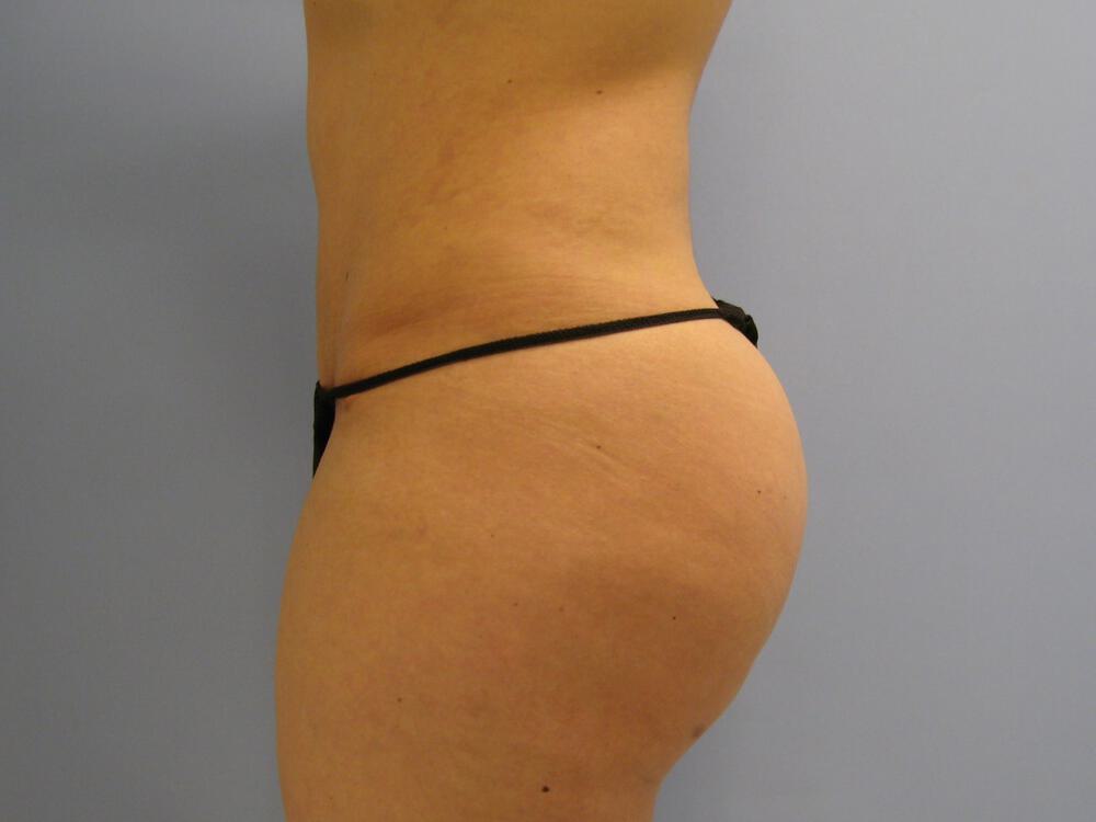 Buttocks Reshaping Before & After Image