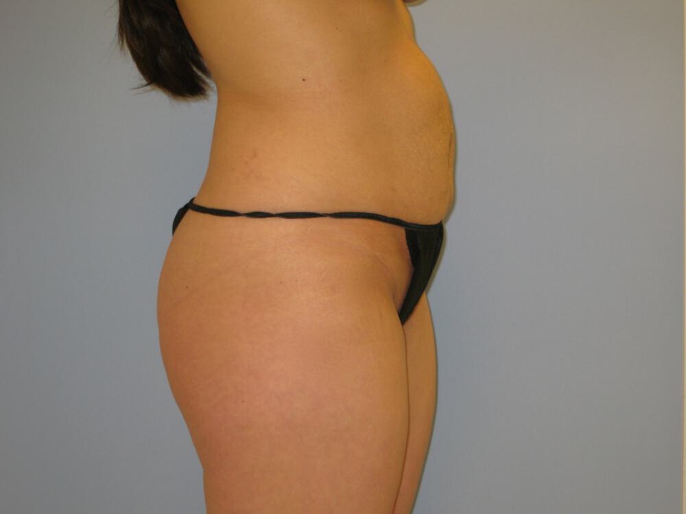 Buttocks Reshaping Before & After Image