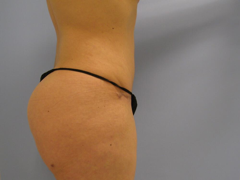 Buttocks Reshaping Before & After Image