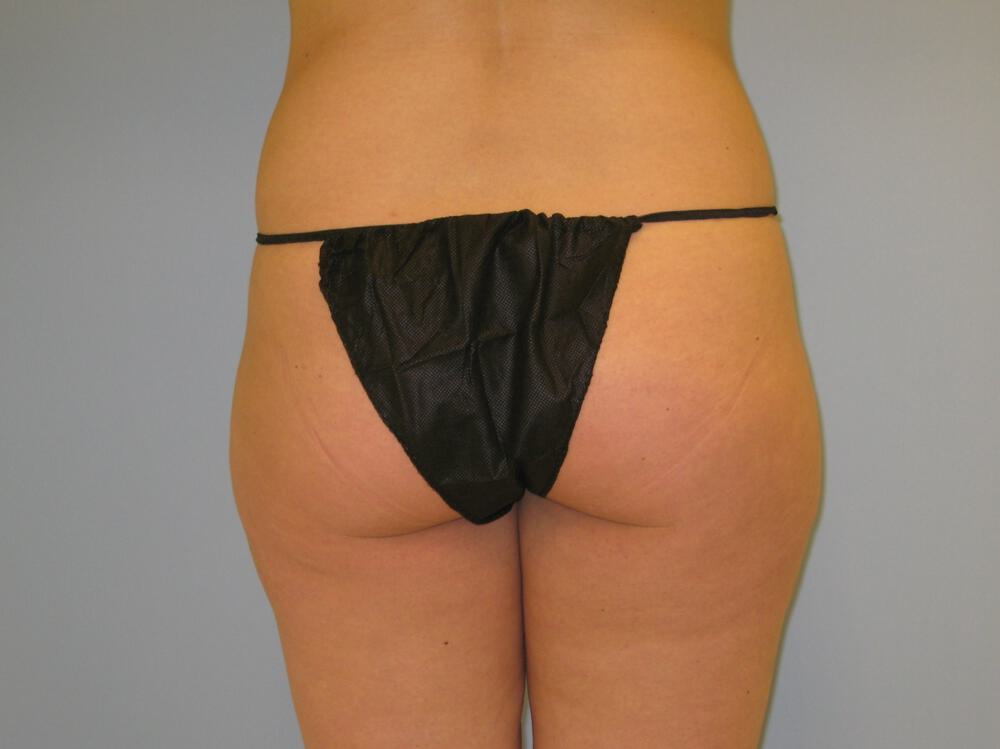 Buttocks Reshaping Before & After Image