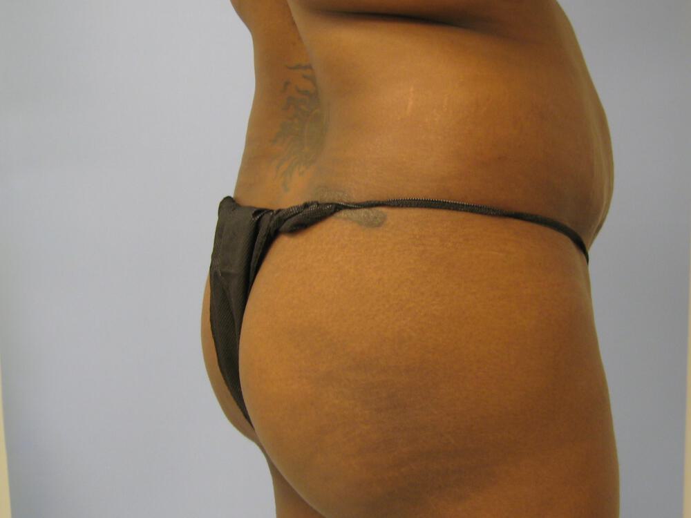 Buttocks Reshaping Before & After Image