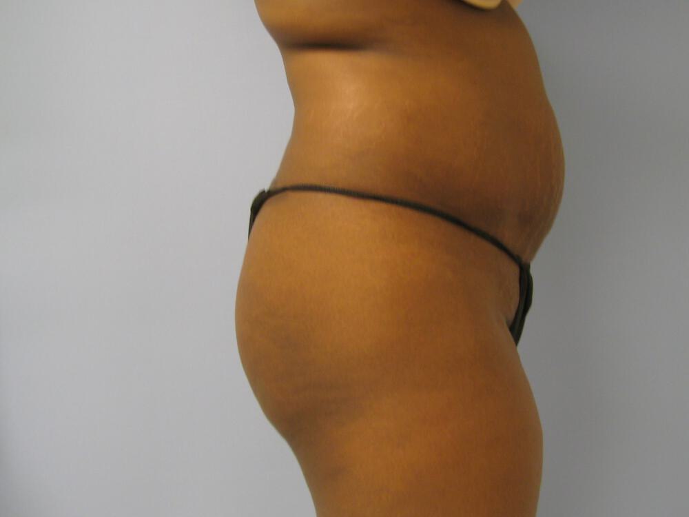 Buttocks Reshaping Before & After Image