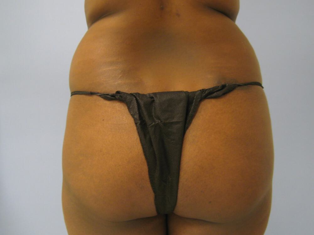 Buttocks Reshaping Before & After Image