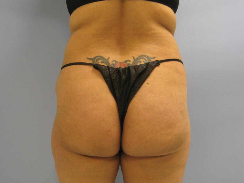 Buttocks Reshaping Before & After Image
